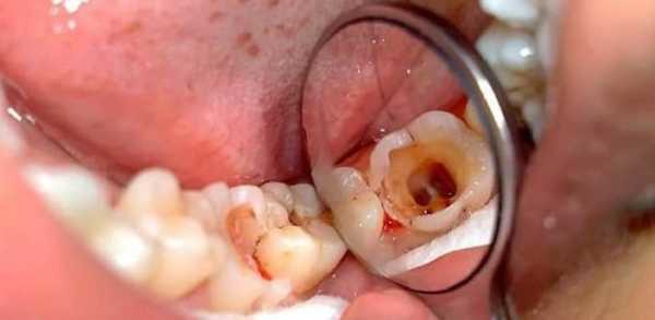 Можно ли спасти мертвый зуб с помощью лечения корневых каналов?