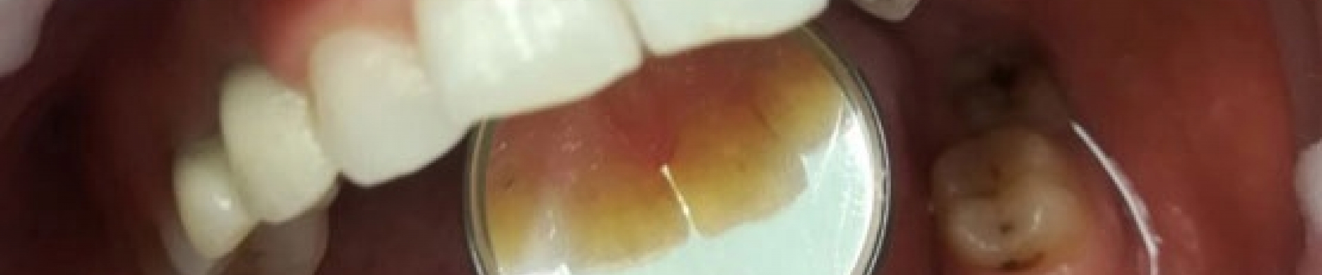 Почему заболевание десен может привести к потере зубов