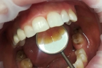 Почему заболевание десен может привести к потере зубов